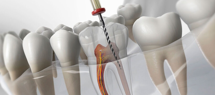 root canal