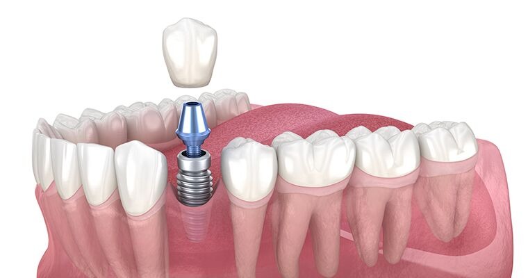 dental implants