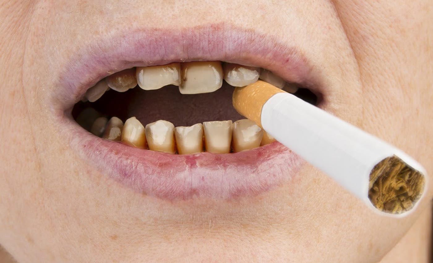 The Impact of Smoking on Oral Health