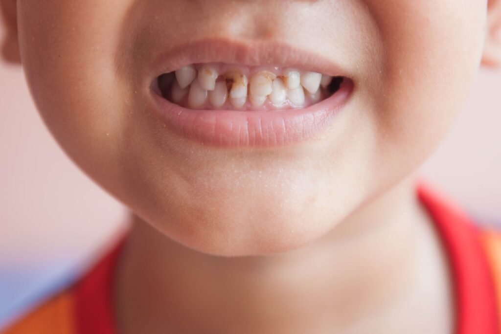 Cavities in Children’s Teeth: Prevention and Treatment Tips