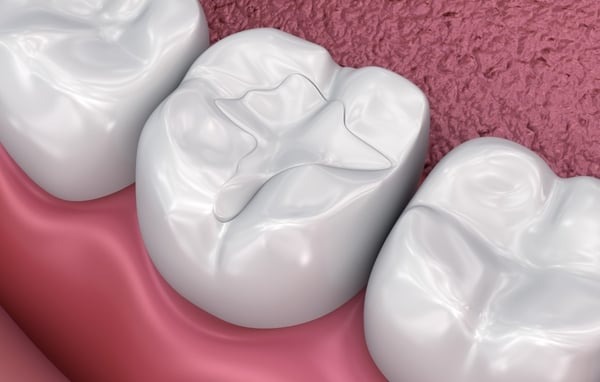 dental restoration